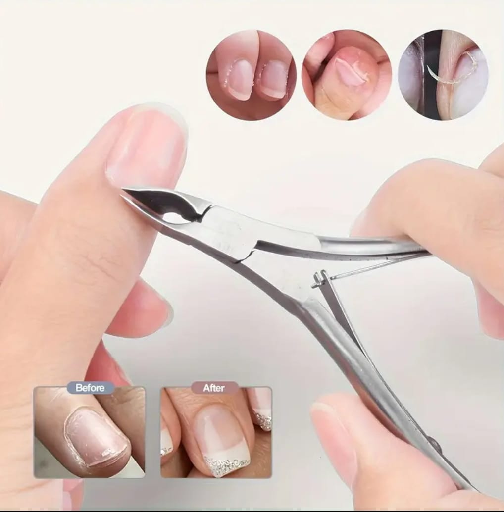 Kit Profesional para Onicocriptosis (Uñas Encarnadas) - 4 Piezas
